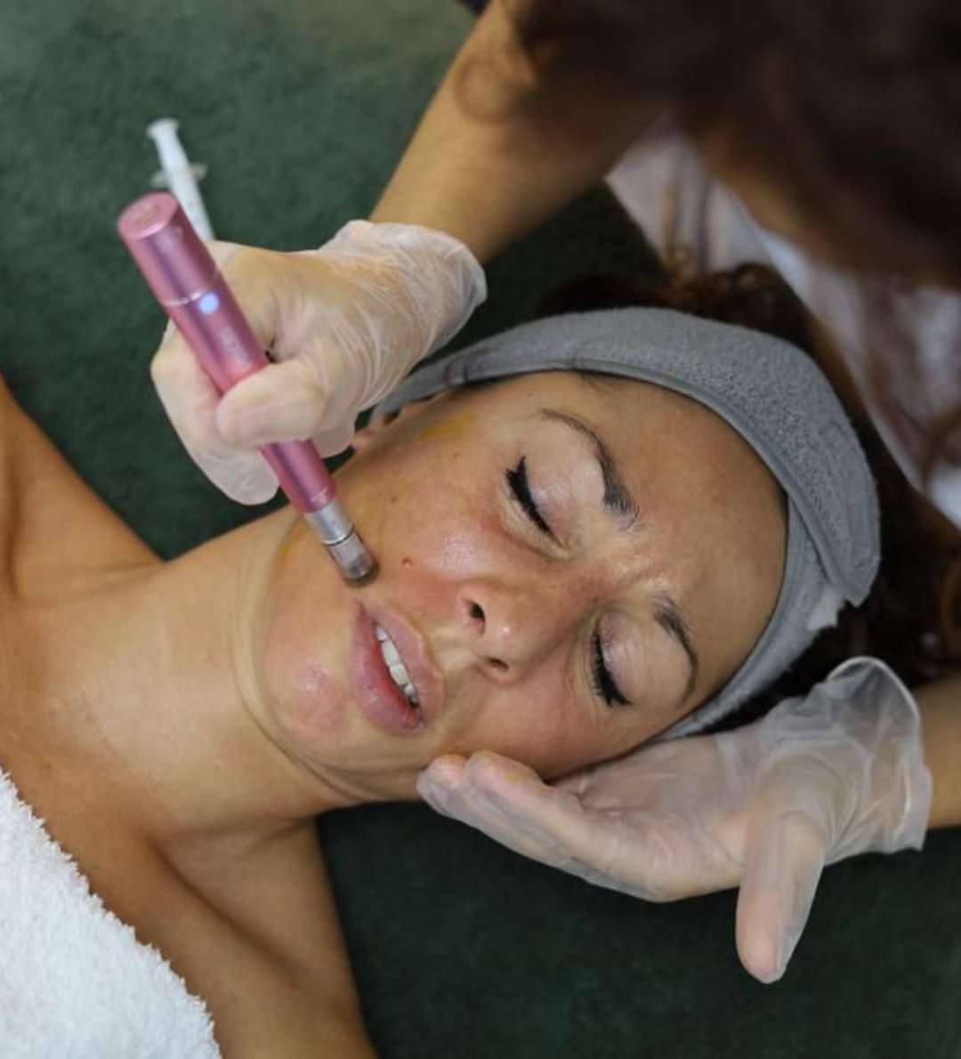 Tratamiento con Dermapen